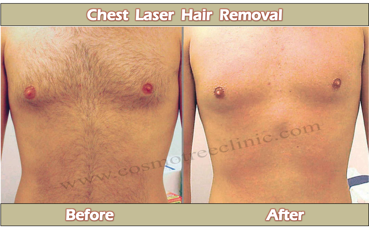 Chest Laser Hair Removal CosmoTree Clinic In Delhi